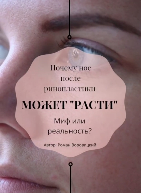 Почему нос после ринопластики может «расти»?